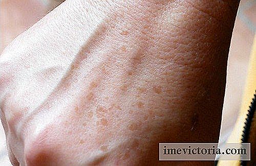 So entfernen Sie Flecken oder Sommersprossen an den Händen