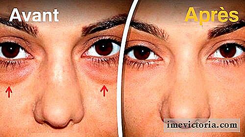 Os 5 melhores remédios para reduzir o inchaço sob os olhos