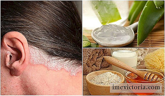 5 Remedii de casă pentru a ameliora psoriazisul scalpului