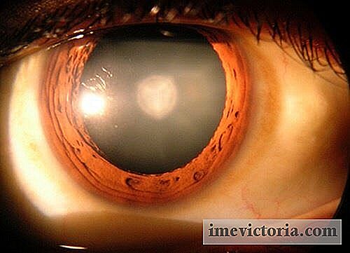 8 Lucruri pe care ar trebui să le cunoașteți despre cataractă