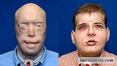 En brannmann av 41 år har vært den mest vellykkede ansiktstransplantasjon i historien