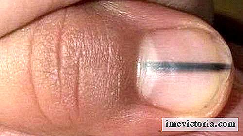 Uma linha preta nas unhas pode ser um sinal de câncer. Você sabia?