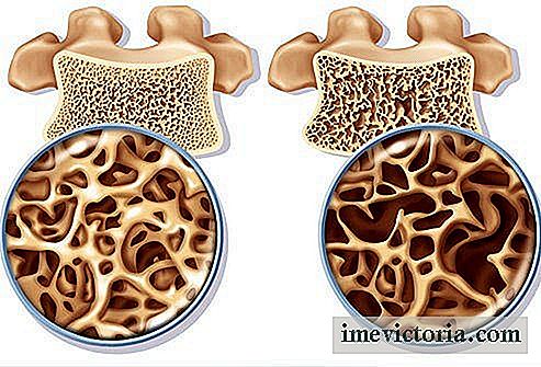 Prävention und Behandlung von Osteoporose bei Frauen