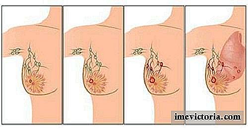 Brystkreft er en type ondartet tumor som kommer fra brystceller.