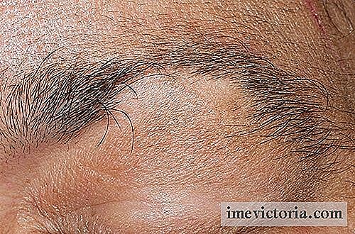 Behandlung von Alopezie der Augenbrauen und Wimpern