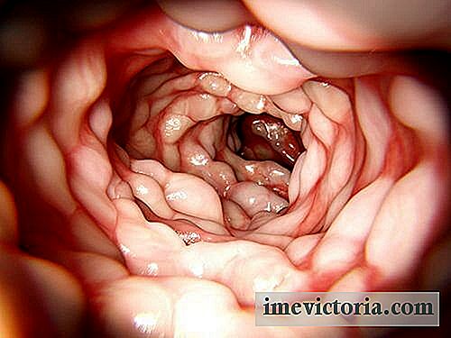 Crohn's Disease Treatment