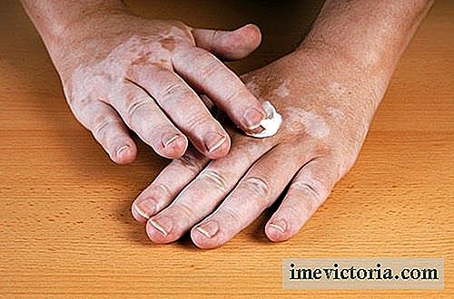 Vitiligo: warum es erscheint und wie man es beseitigt?