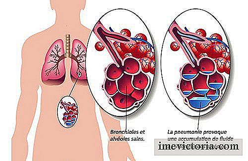 7 Alimenti per il trattamento della polmonite