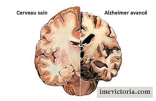 Alzheimer: hoe de eerste symptomen te herkennen