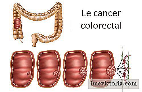 Cum de a recunoaște și de a preveni cancerul colorectal?