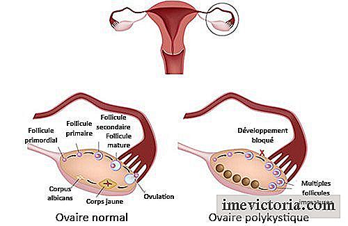 Sindromul ovarului polichistic