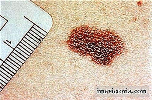 Semne ale cancerului de piele nu trebuie neglijate