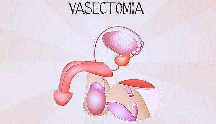 Vasektomie - Chirurgie und Umkehrung
