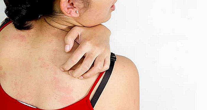 8 Ursachen von roten fleckigen Hautkratzern
