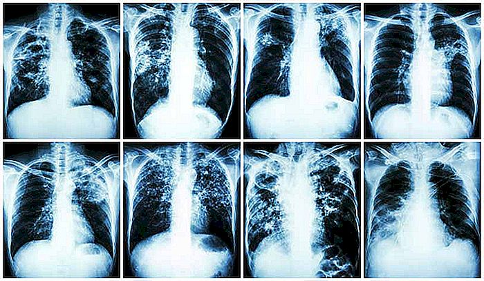 Tuberkulose - Ursachen, Symptome und Behandlung