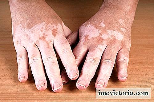 5 Hjem rettsmidler for å lindre vitiligo