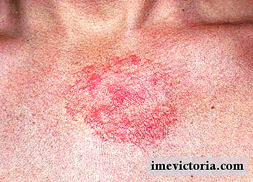 5 Remedii pentru a vindeca dermatita