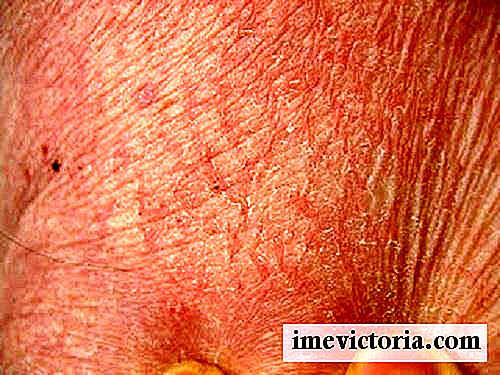 5 Oppskrifter for behandling av tørr hud i forskjellige kroppsdeler