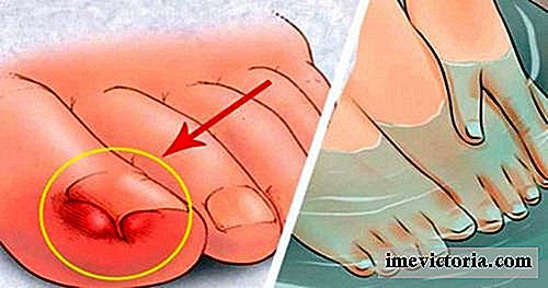 6 Acasă căi de atac pentru a calma unghiile incarnate