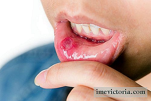 6 Remedii pentru ulcerații la nivelul gurii