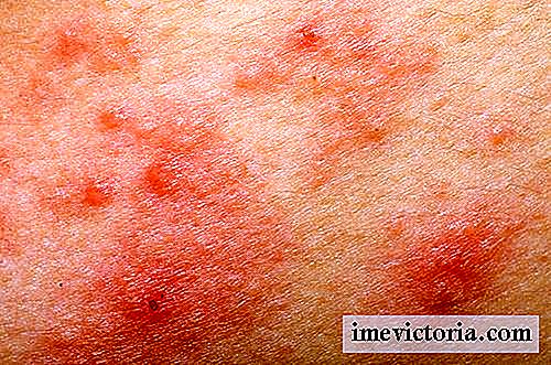 9 Rimedi naturali contro l'acne rosacea