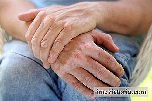 9 Natuurlijke remedies tegen vitiligo