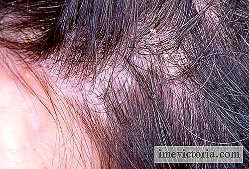 Um tratamento para o eczema no couro cabeludo