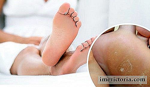 Elimine os calos com os pés com este remédio eficaz