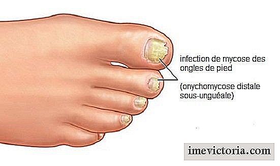 Svampar kan förekomma i någon del av kroppen, även om de vanligaste är runt naglarna, på fötterna eller där det är Det finns mer fukt eller värme, som armhålor.