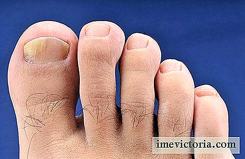 De home remedies voor de behandeling van onychomycosis (handen en voeten)