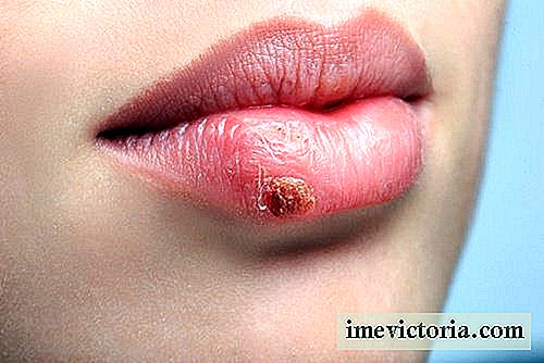 Come prevenire e curare naturalmente herpes labiale