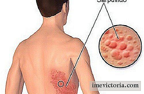 Cum de a trata în mod natural herpesul zoster