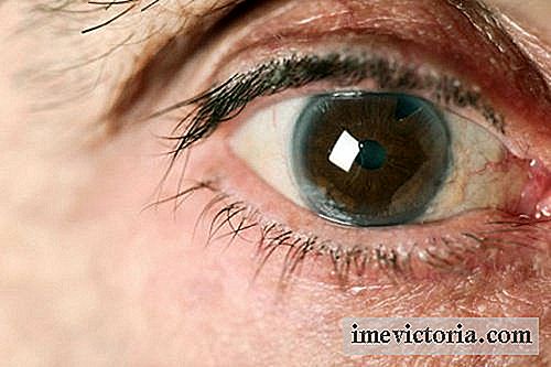 Como prevenir glaucoma naturalmente