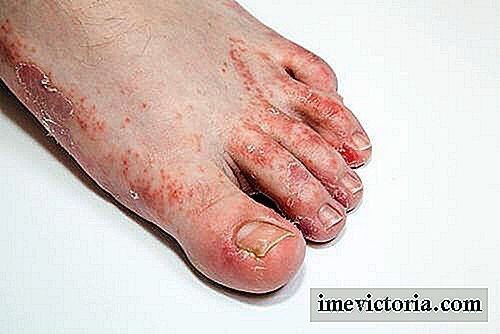 Mykos på fötterna? ! 3 botemedel för permanent eliminera