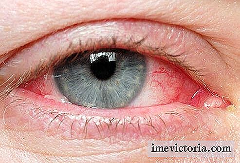 Naturlige tips for å behandle irriterte øyne