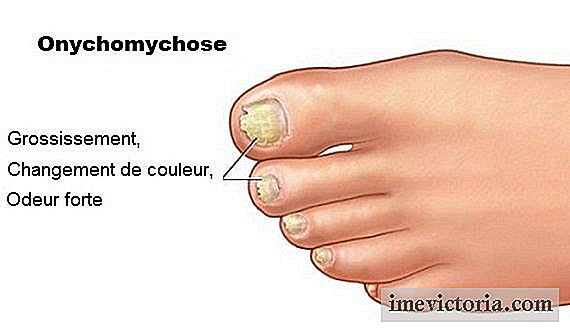 Onychomycosis: når sopp påvirke tåneglene