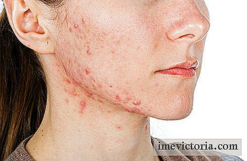 6 Trin for at fjerne acne varig