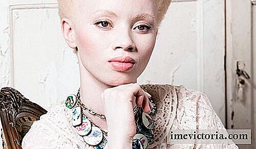 Albinismus: uštěpačná příklad supermodelka Thando Hopa