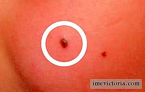 ¿Cómo deshacerse de pequeños puntos rojos en la piel?