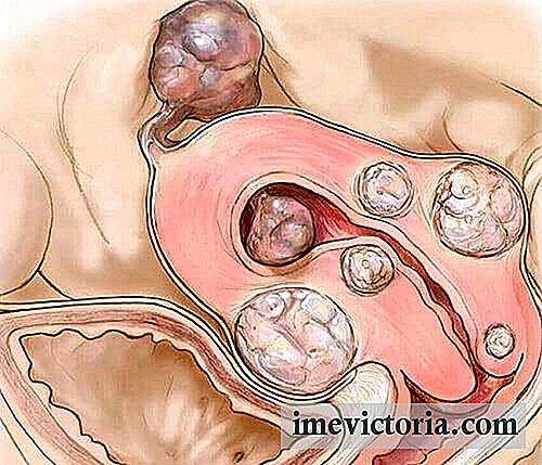 5 Věcí, které je třeba vědět o děloze Myomas