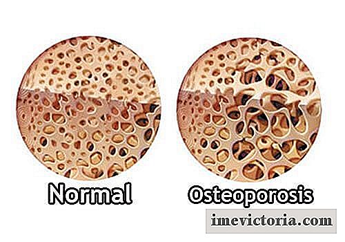 Jak kontrolovat osteoporózu během menopauzy