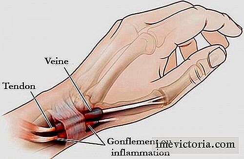 Tenosinovitis: inflamación de las manos y los pies para saber