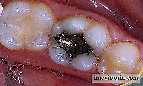 Risikoen for dental fyld sundhed