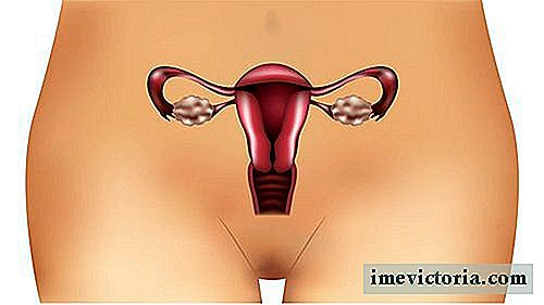 Síntomas Unsung síndrome de ovario poliquístico