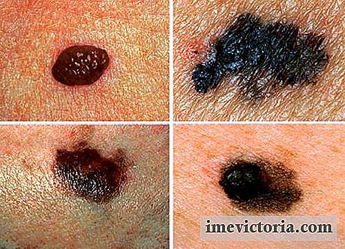 Výstražné příznaky, které svědčí o rakovině kůže