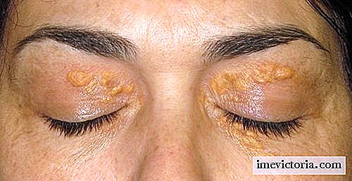 Xantelasmas: estas manchas blancas alrededor de los ojos