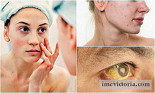 7 Síntomas que afectan su rostro cuando padece deficiencias nutricionales