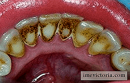 Slik eliminerer du tannplakk og forbedrer oral helse