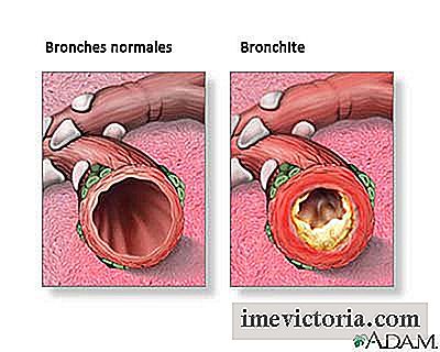 Bronkitis naturlig behandling af