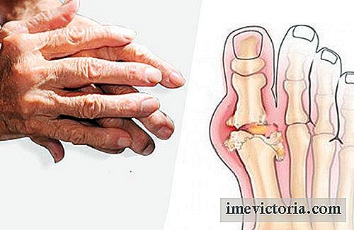 Recomendaciones para el alivio de la artritis